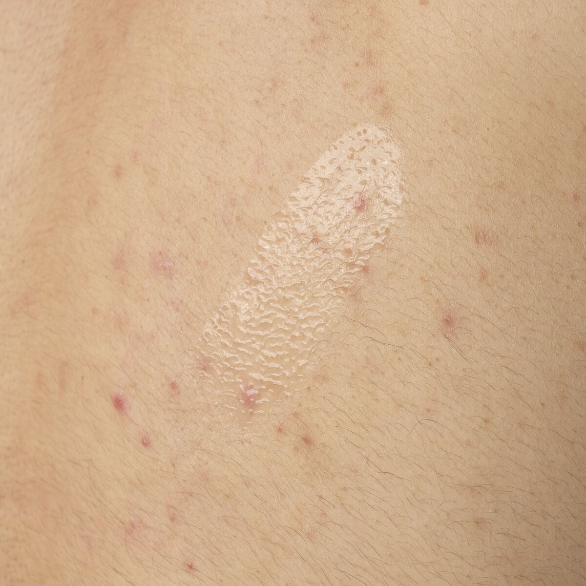 salicylic-acid-0-5-body-serum-e8 ORD-salicylic-acid-05-body-240ml-application.jpg