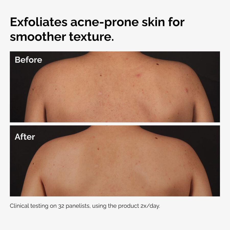 salicylic-acid-0-5-body-serum-e8 ord-salicylic-acid-body-serum-before-after-graphic-NA.jpg